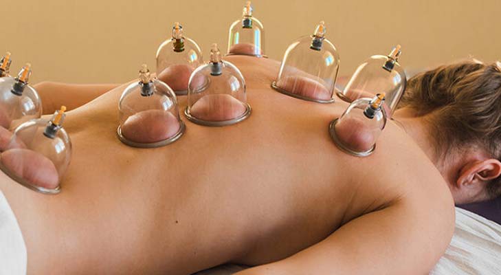 Hijama-Cupping-Therapy